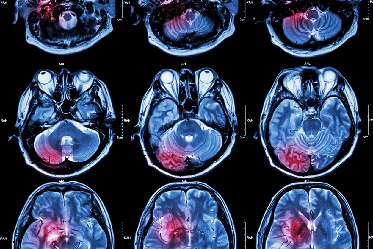 Brain MRI scans with highlighted areas
