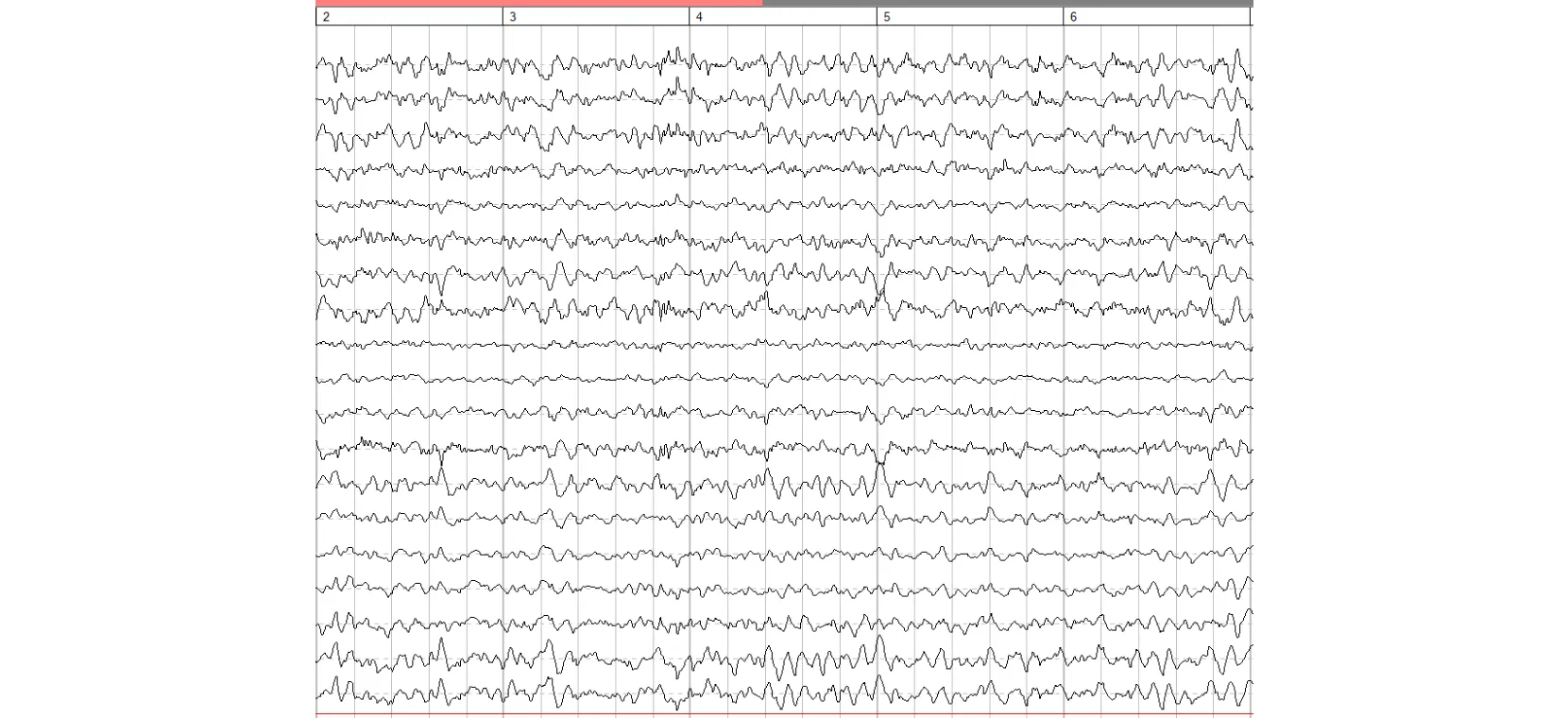 EEG recording showing brain wave activity with distinct rhythmic patterns.